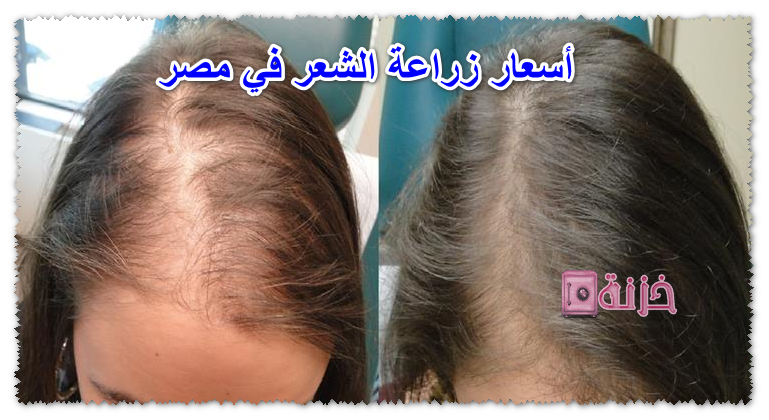 أسعار زراعة الشعر في مصر